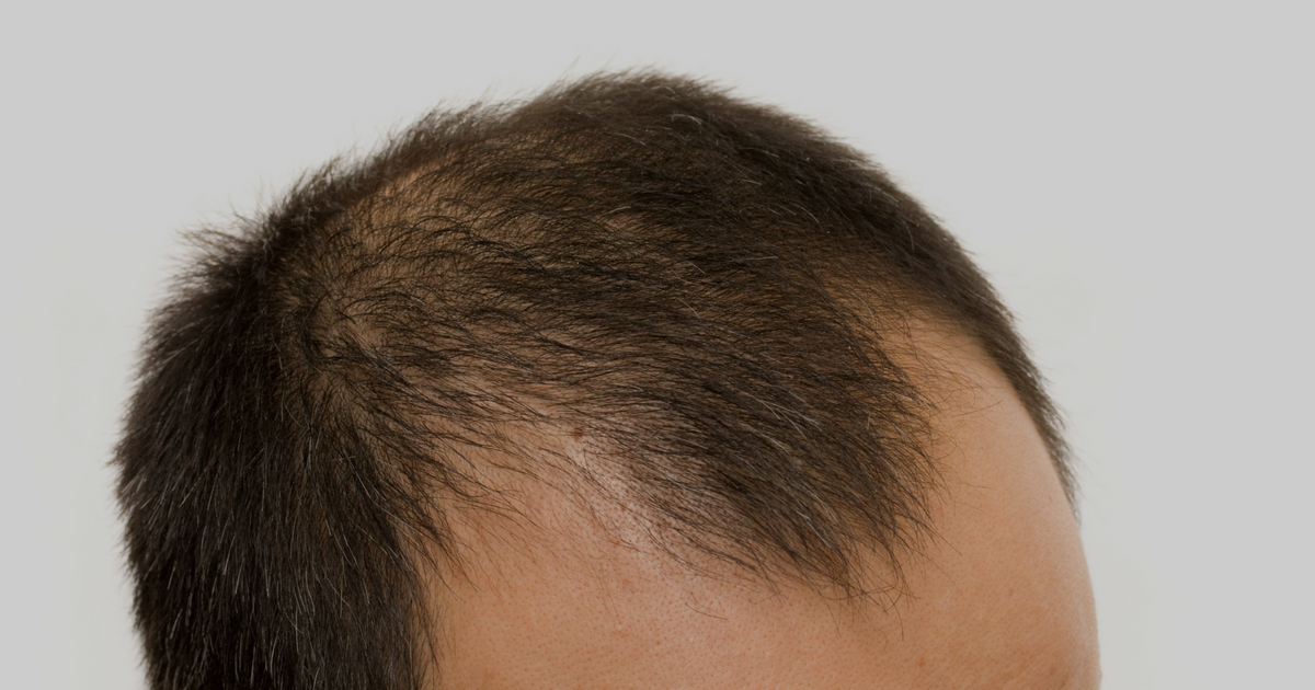 scalp micropigmentation procedures for men