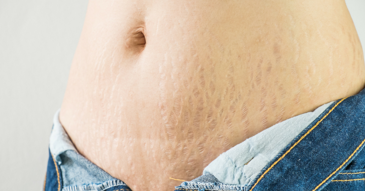 scar and stretchmark camouflage and treatments